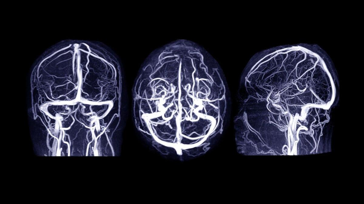 Che cos'è l'Ictus e come prevenirlo - 