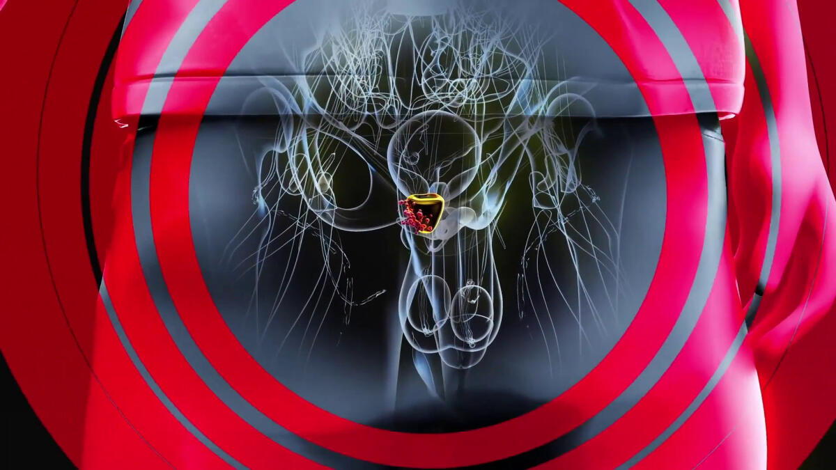 Disturbi della prostata, occhio ai sintomi - 