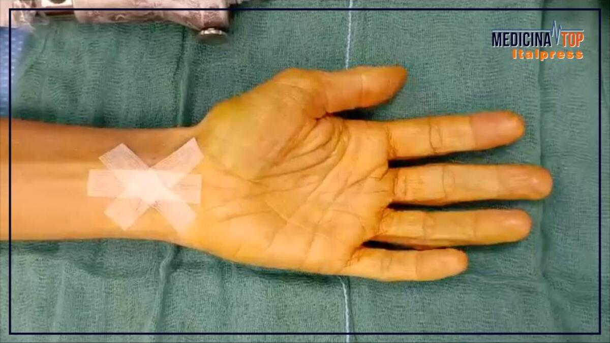 Sindrome del tunnel carpale, anche artrite e obesità tra le cause - 