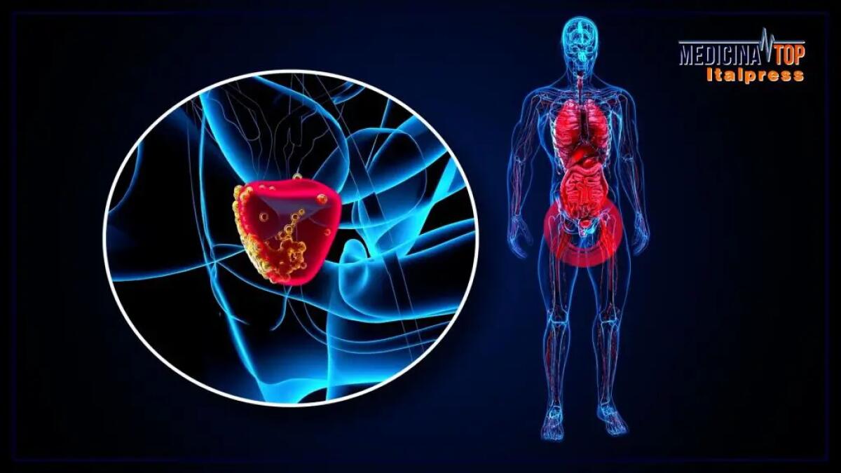 Tumore della prostata, in Italia 40 mila nuovi casi ogni anno - 