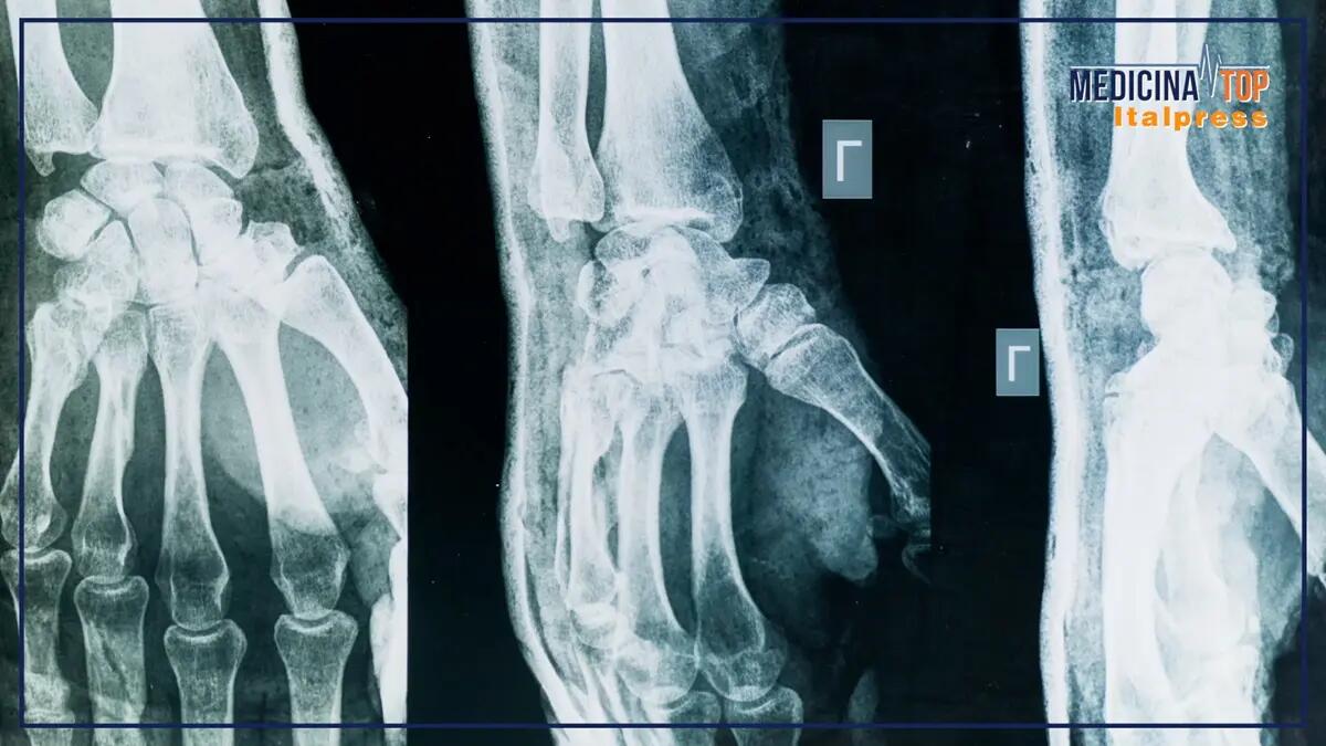 Artrite e artrosi, sintomi comuni ma cause e cure diverse - 