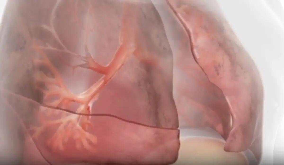 Innovazioni terapeutiche nella BPCO con enfisema - 