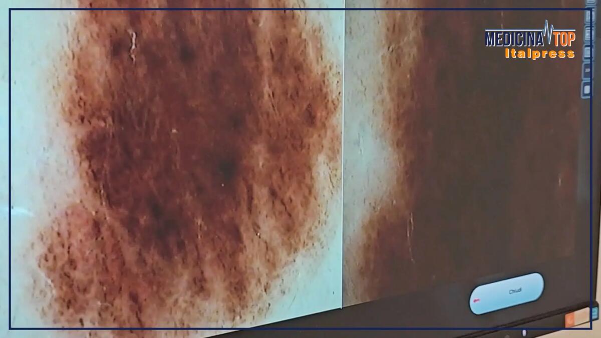 Tumori cutanei non melanoma in costante aumento in Italia, ecco perché - 