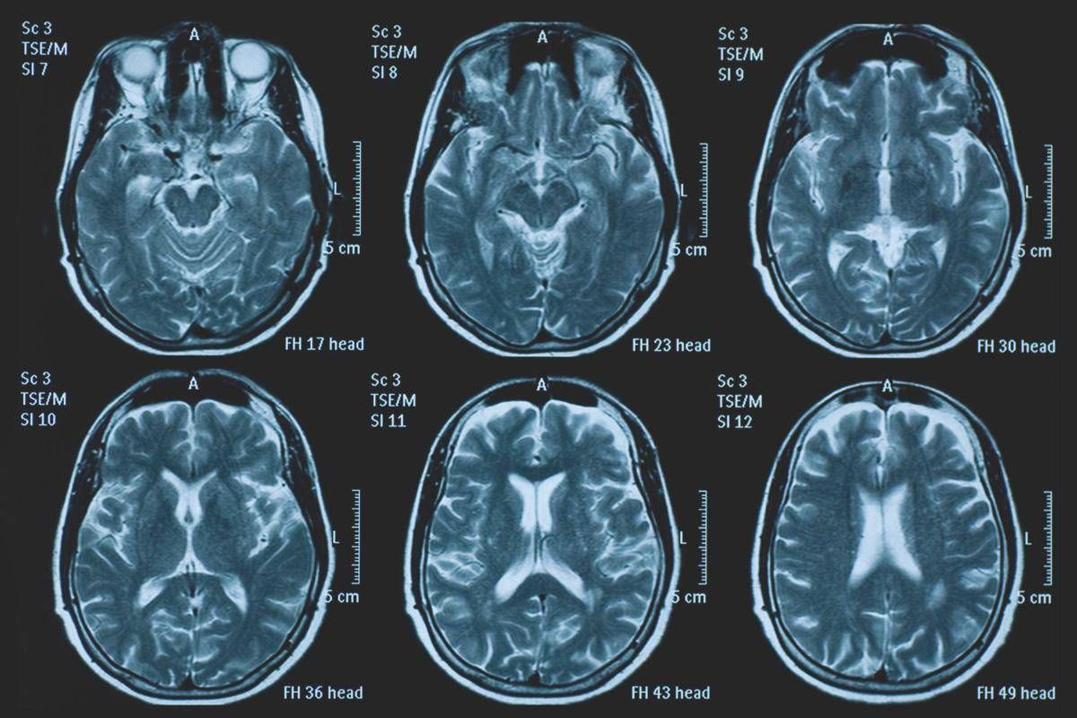 Tumori, glioma pediatrico di basso grado: via libera in Europa a prima terapia mirata - 