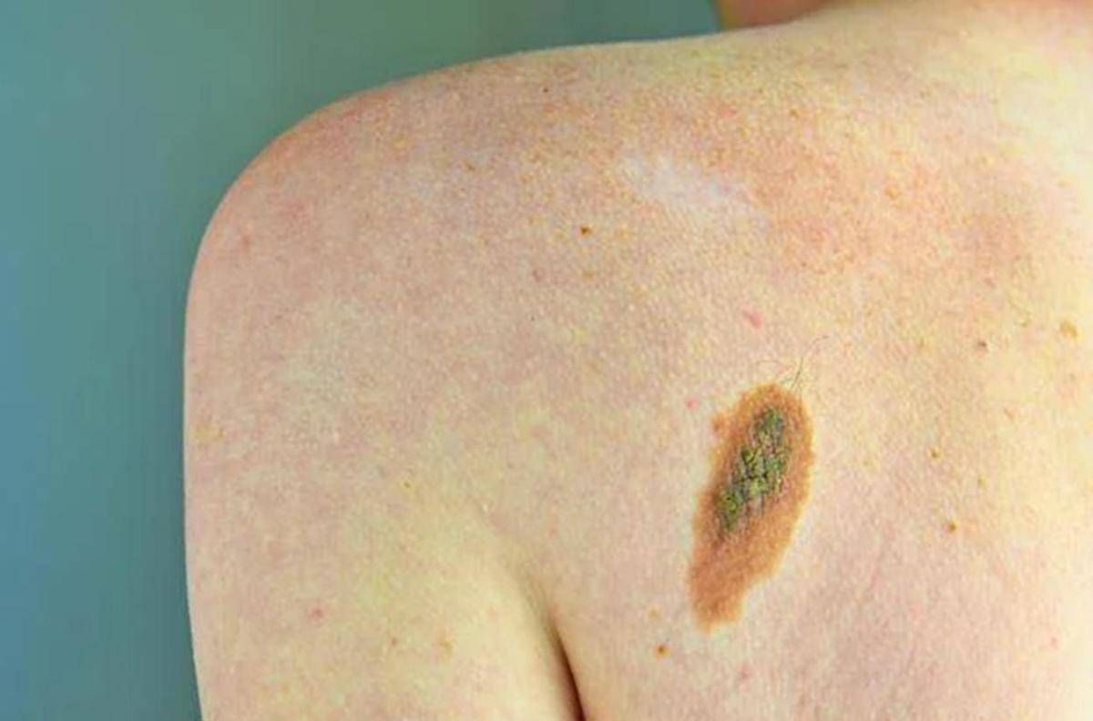 Ogni anno in Italia 2.600 casi ereditari di melanoma, Imi:"Prevenzione con test genetici e controlli" - 
