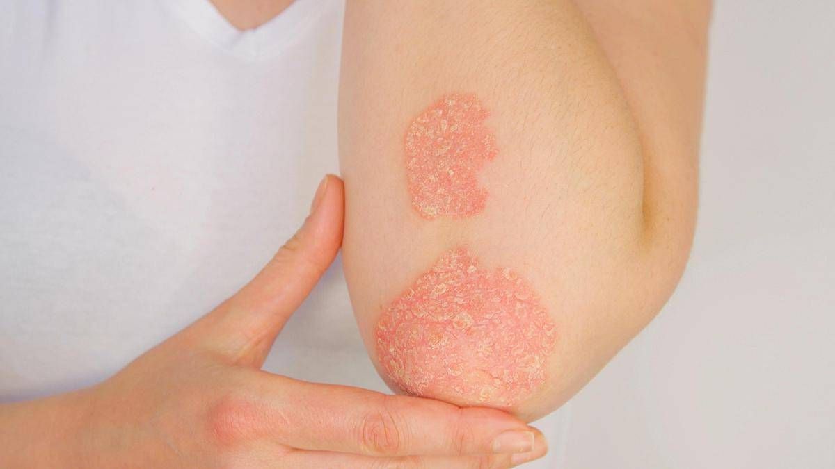 Psoriasi, dati positivi per inibitore orale di Tyk2 di nuova generazione - 