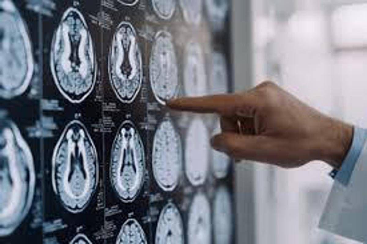 Stop tremori Parkinson senza bisturi, 10 pazienti curati con ultrasuoni a Napoli - 