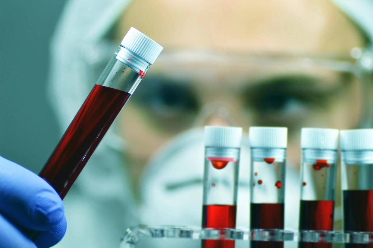 Giornata patologie eosinofile, ematologa Iurlo 'fino a 5 anni per diagnosi' - 