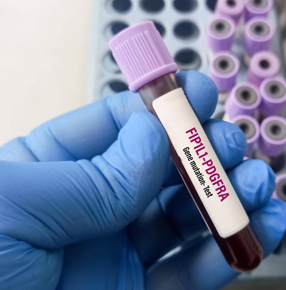 Giornata patologie eosinofile, allergologo Caminati: "Diagnosi complessa" - 