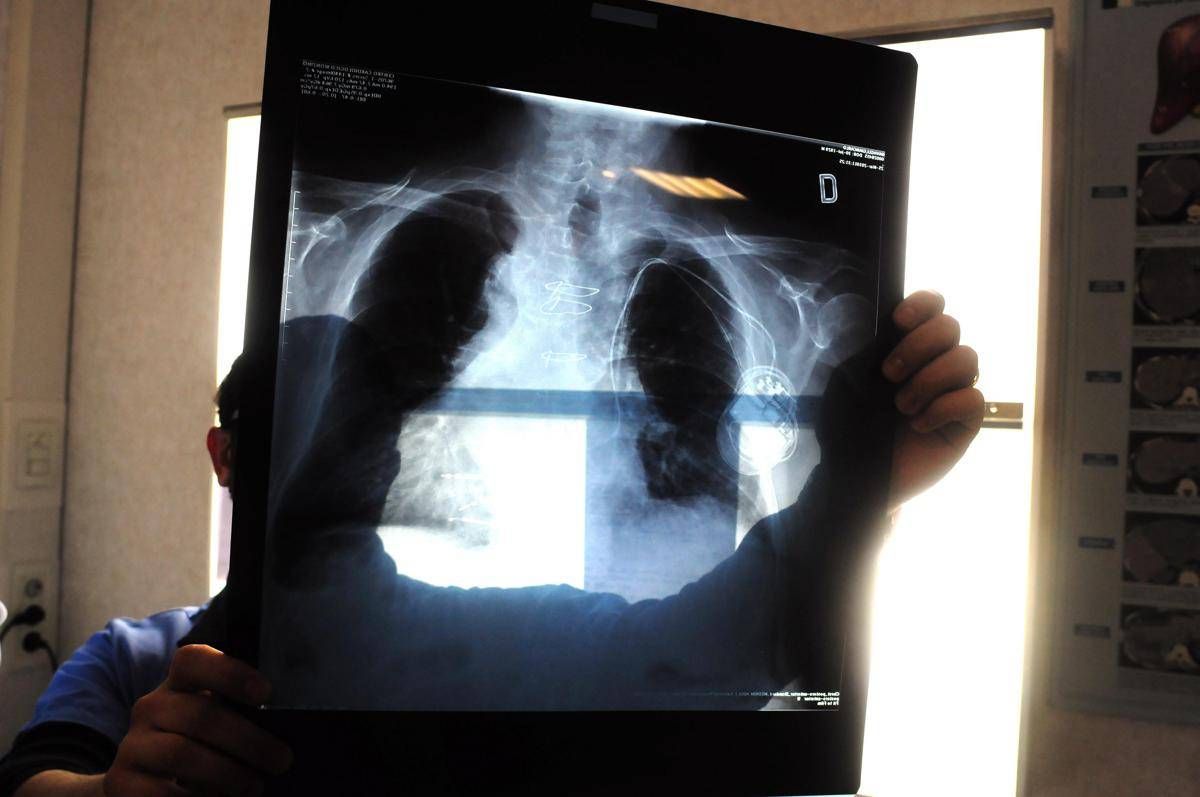 Sirm: "Ai strumento anti liste d'attesa, 50% esami imaging per over70 non necessario" - 