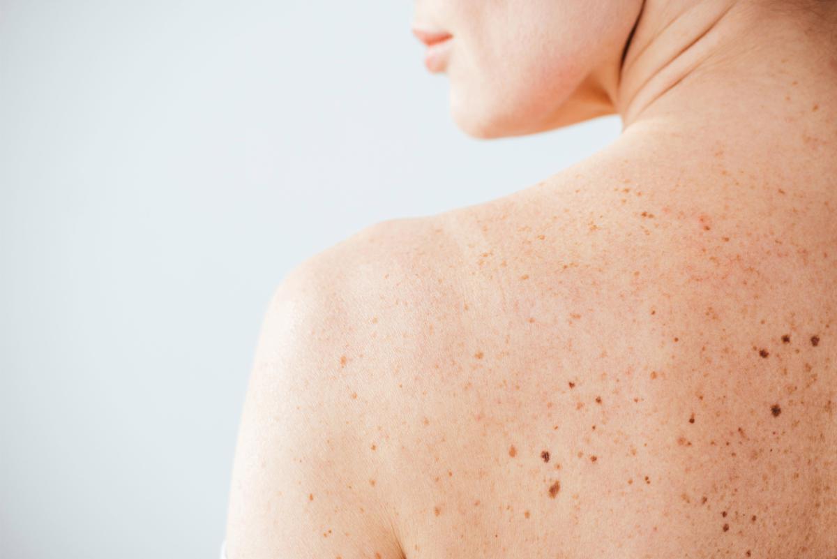 Nei e sole, Sidemast lancia la Giornata della prevenzione dermatologica - 