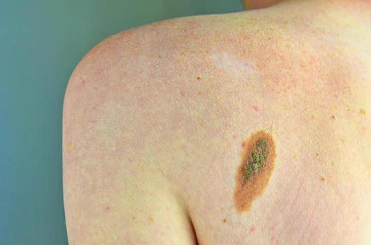 Melanoma, Adoi: "Bene nuova legge su prevenzione, dermatologo centrale in screening" - 