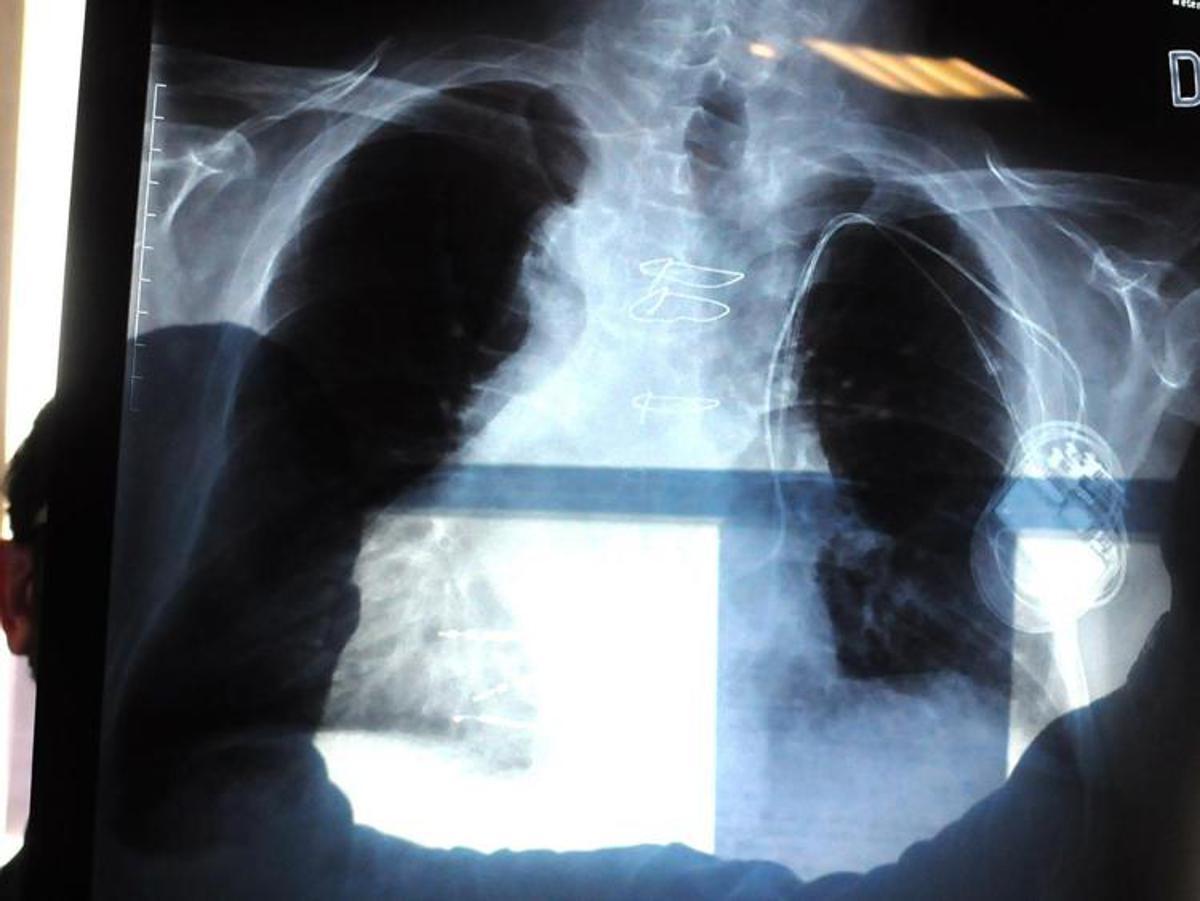 Bpco, pneumologa Foschino Barbaro: "Nella donna sintomi diversi, attenzione alle giovani" - 