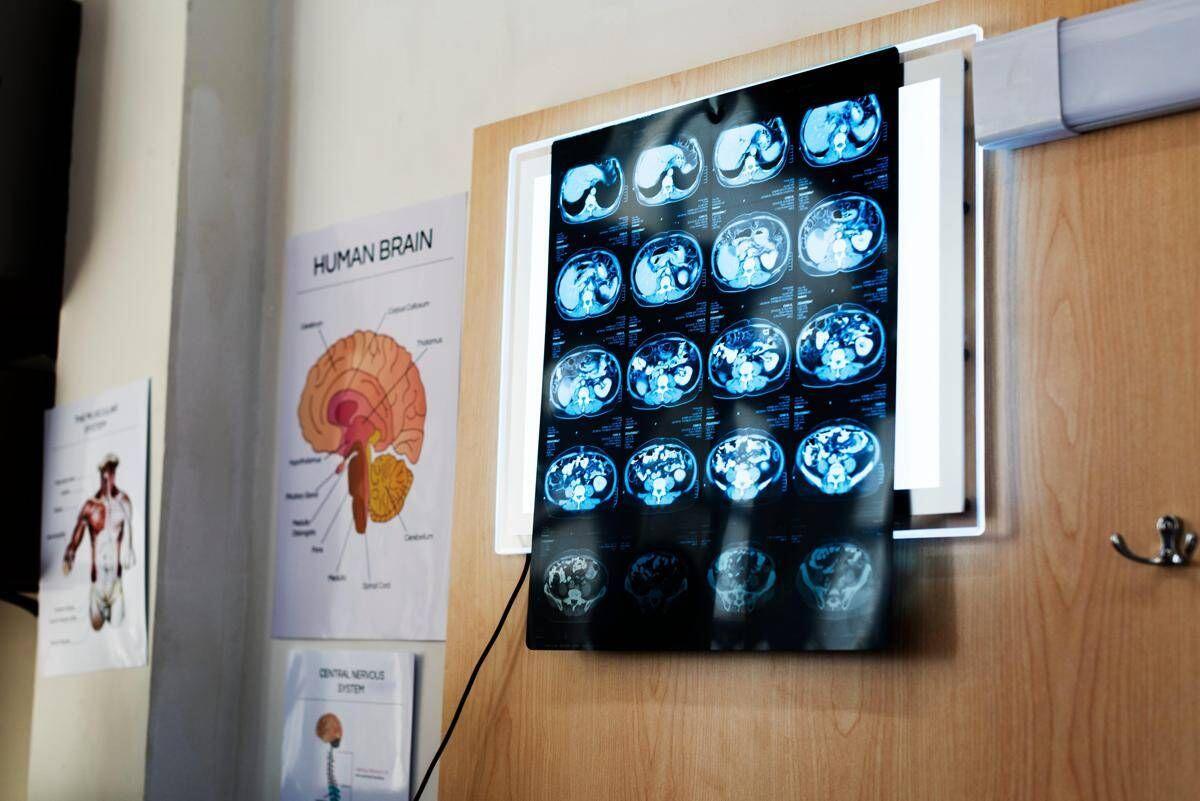 Di Battista, cosa indica un mal di testa forte e improvviso: le ipotesi del neurologo - 