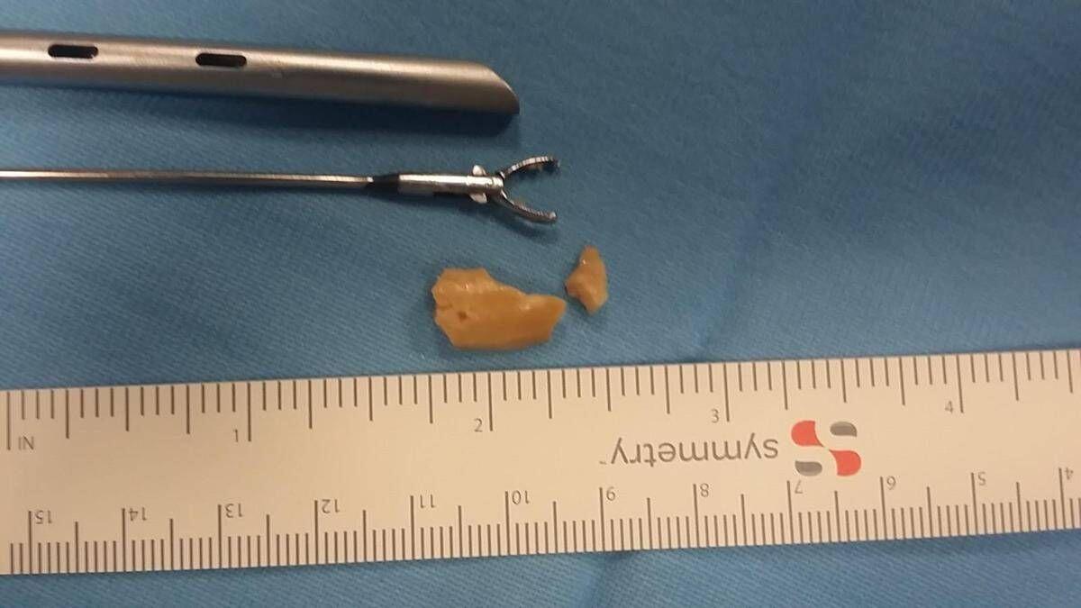Aveva una nocciola bloccata nei bronchi da due settimane, salvata bimba di 20 mesi - 