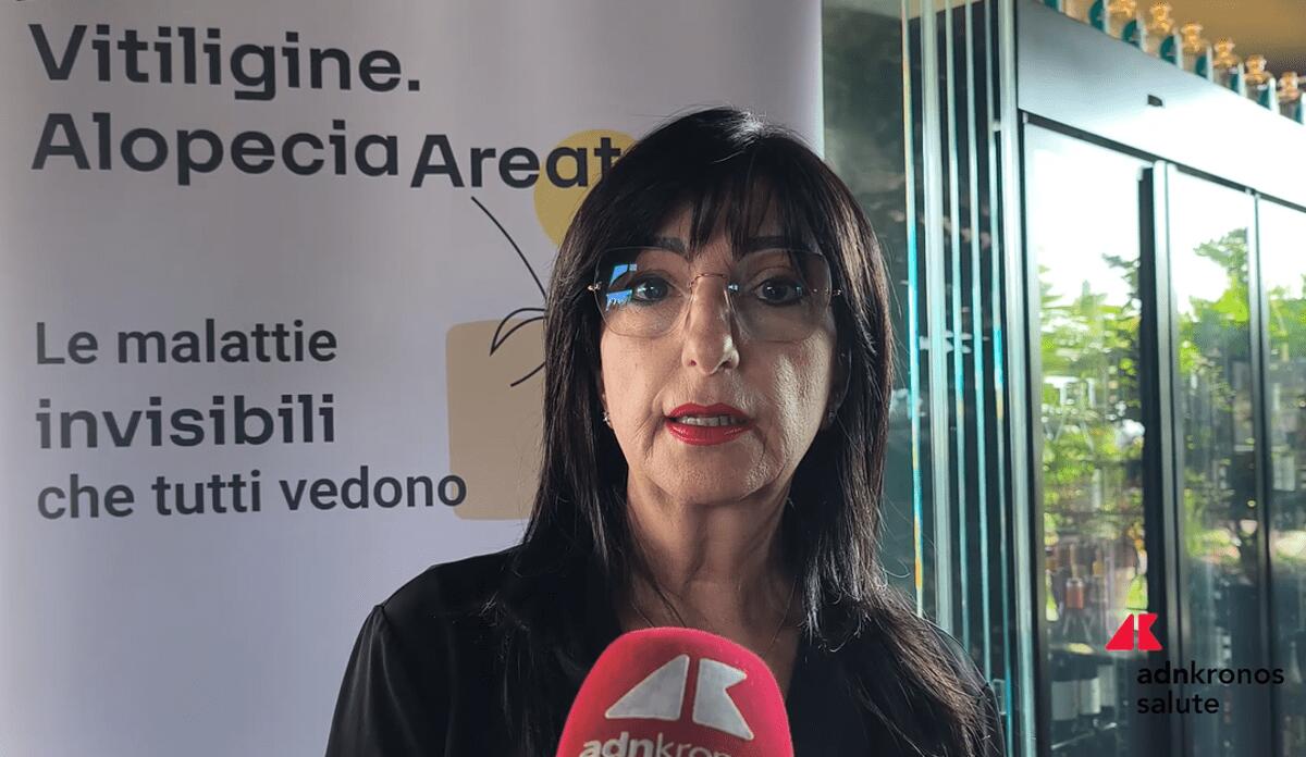 Cassia (Aipaf): "Con nuove terapie Ssn riconosca alopecia per sostenere i pazienti" - 