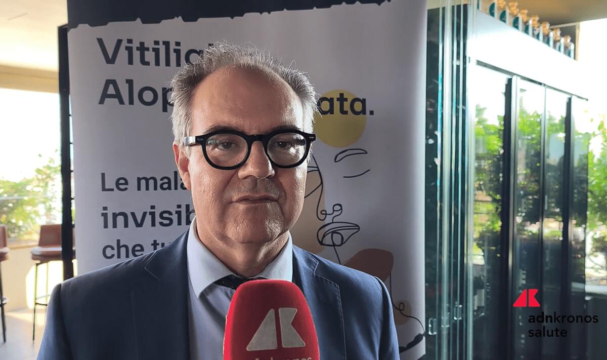 Costanzo (Sidemast): "Upadacitinib blocca cellule infiammatorie in vitiligine e alopecia areata" - 