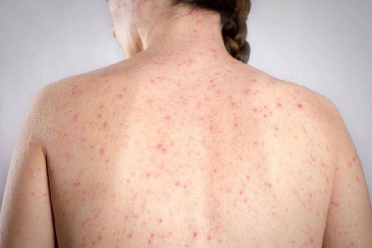 Morbillo, l'allarme dell'infettivologo Andreoni: "Casi in crescita, ricoveri frequenti negli adulti" - 