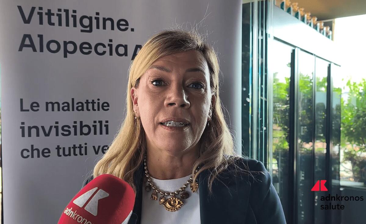 Cordella (AbbVie): "Vitiligine e alopecia siano riconosciute da Ssn" - 
