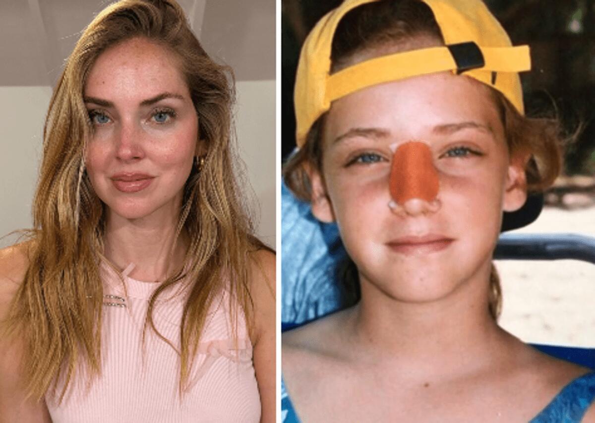 Chiara Ferragni, l'intervento al naso: "Ecco perché è storto ora" - 
