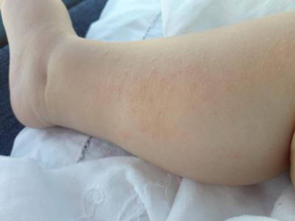 Dermatite atopica, Aifa estende rimborso di upadacitinib dai 12 anni di età - 