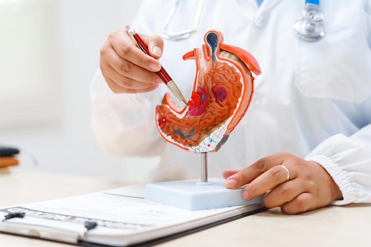Cancro allo stomaco avanzato, nuova terapia riduce del 42% il rischio di morte ﻿ - 