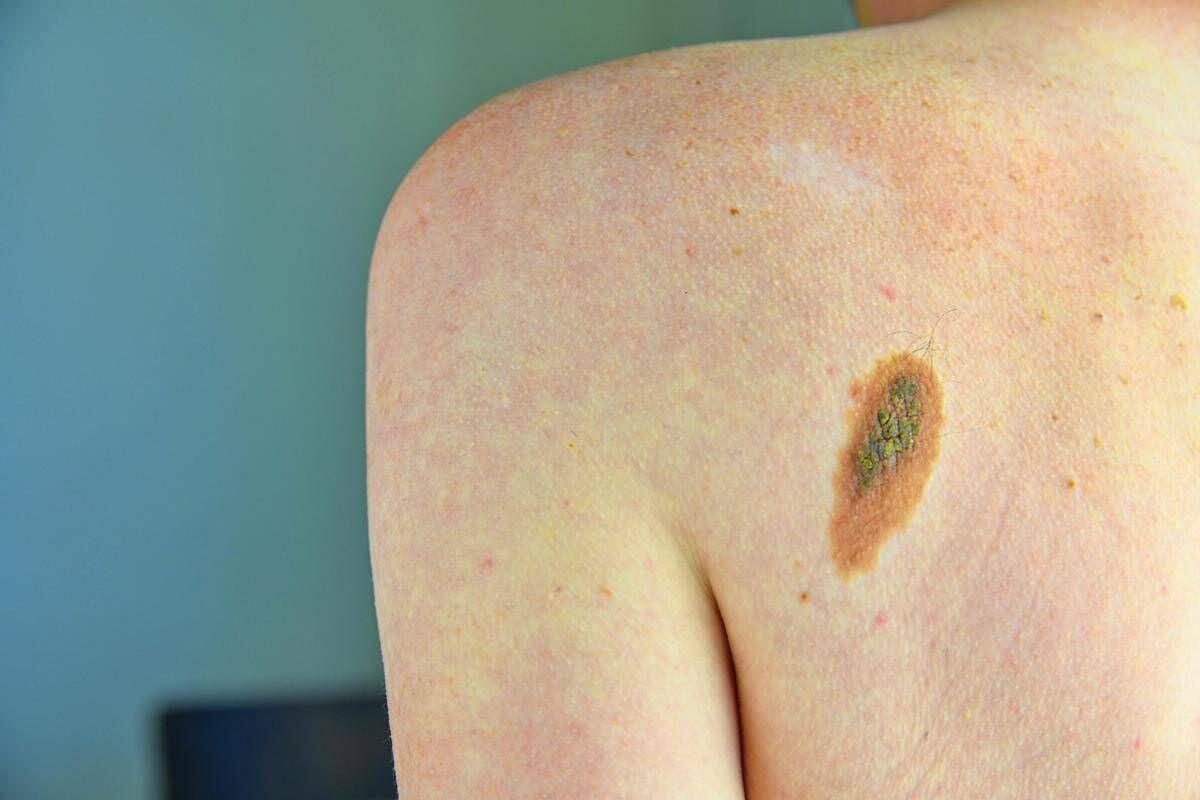 Melanoma, la firma mutazionale del cancro potrà cambiare la cura﻿ - 